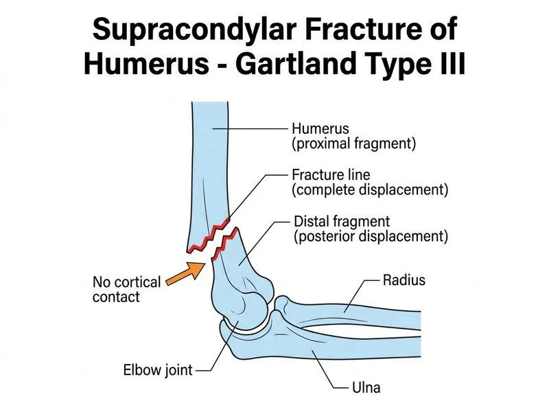 Supracondylar Fracture of Humerus diagram