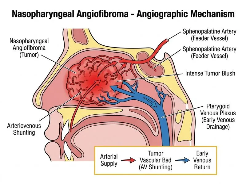 Nasopharyngeal Angiofibroma diagram