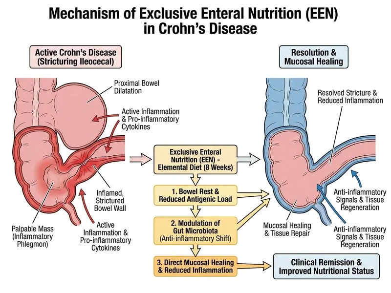 Inflammatory Bowel Disease diagram