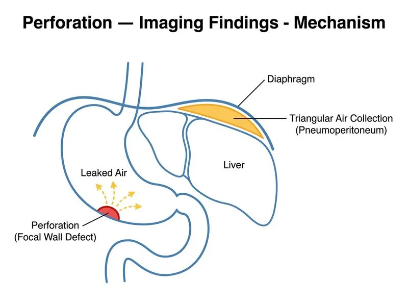 Perforation — Imaging Findings diagram