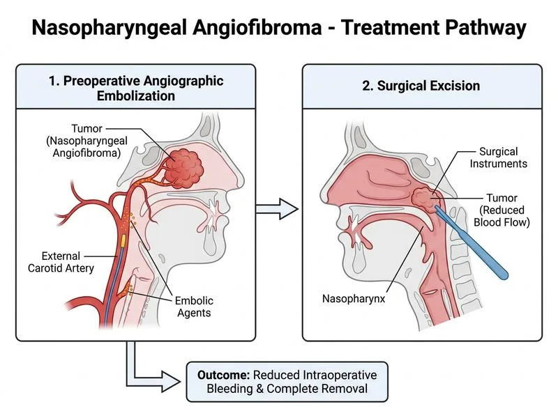 Nasopharyngeal Angiofibroma diagram