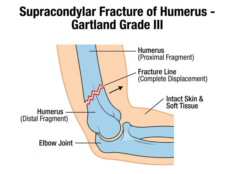 Supracondylar Fracture of Humerus diagram