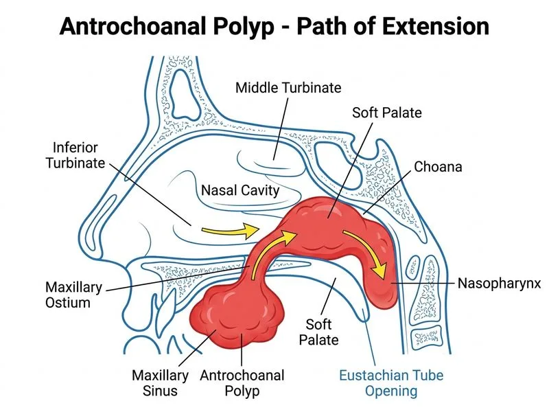 Nasal Polyps diagram