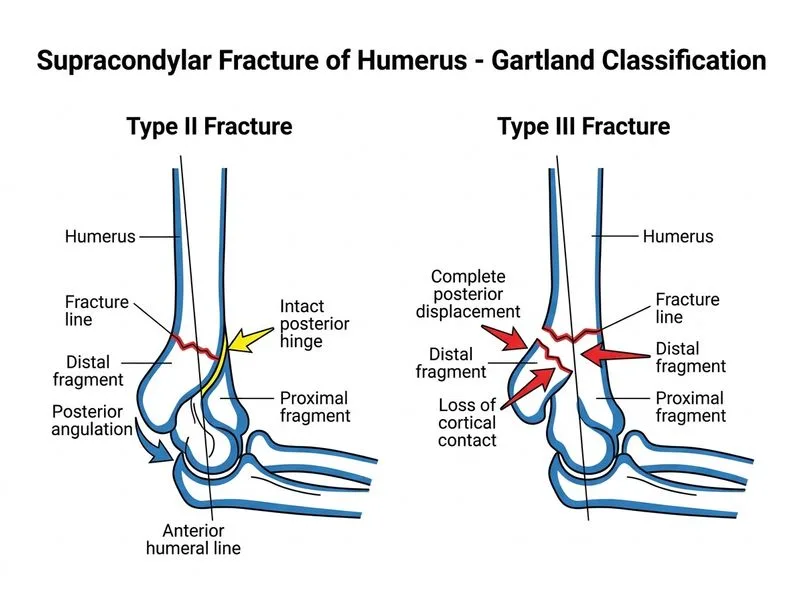 Supracondylar Fracture of Humerus diagram
