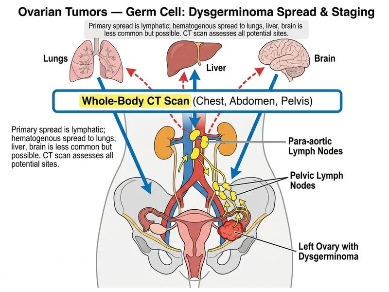 Ovarian Tumors — Germ Cell diagram
