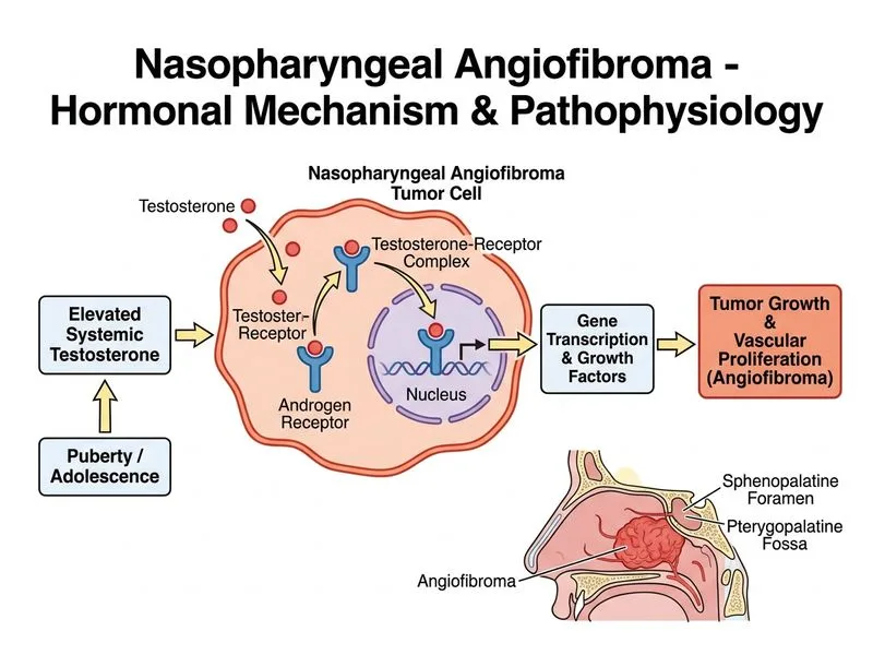 Nasopharyngeal Angiofibroma diagram