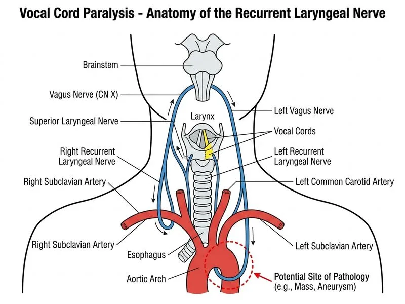Vocal Cord Paralysis diagram
